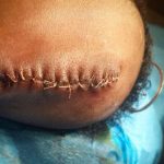 Baby's head freshly stitched after the surgery to remove a congenital malformation