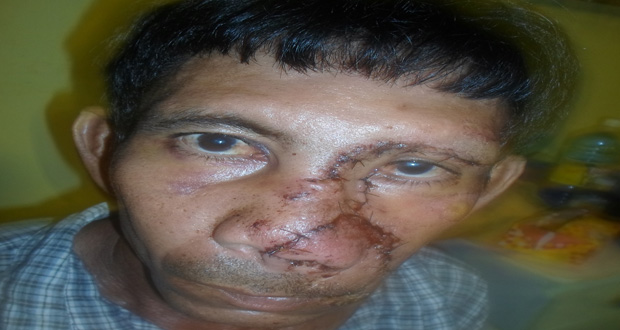 Still awaiting police intervention: Yethong Sueeyee, beaten and chopped on the face by the aggressors.