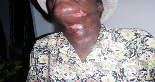 The Pastor's neck that is badly bruised after the bandit reportedly choked her