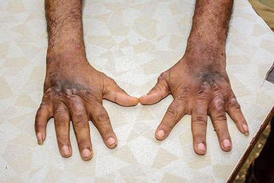 Another Leprosy patient displaying sections of his hands that are now numb as a result of Leprosy 