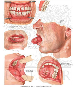 gonorrhea mouth sore