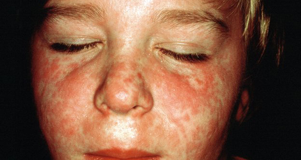 In the developed world, measles is seen as a mild condition - but it can kill
