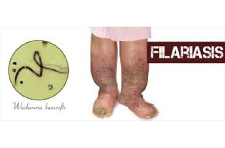 Picture with a leg infected with lymphatic filariasis (filaria)