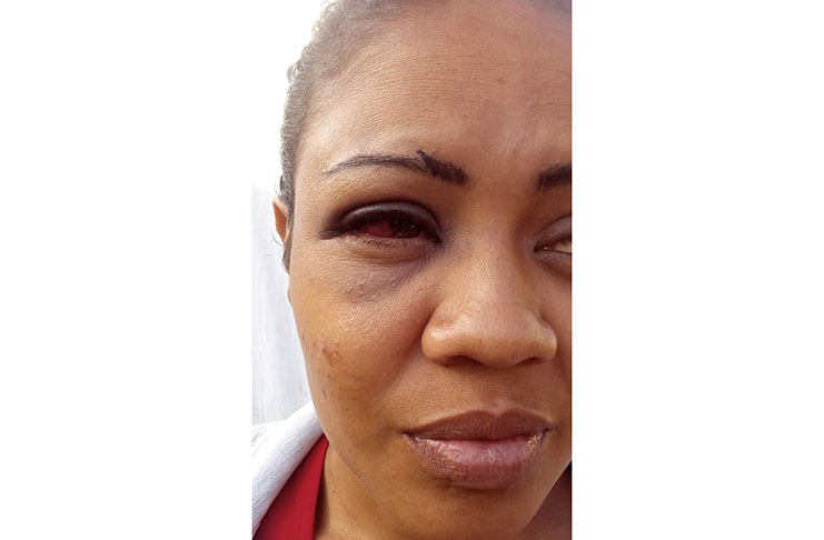 This is how Maxine Duncan-Seenauth’s face has been battered