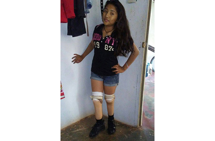 Tamia Lewis recently posing with her prosthetic legs.