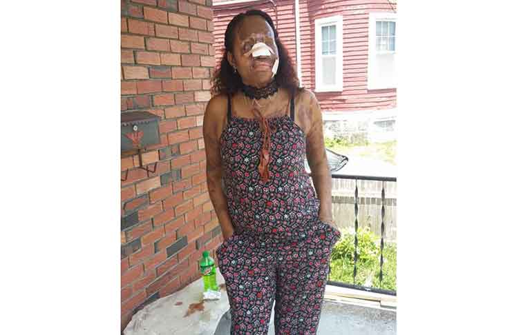 Shondell Williamson as she looks today after 17 months of treatment (Photo courtesy SHEA Foundation)