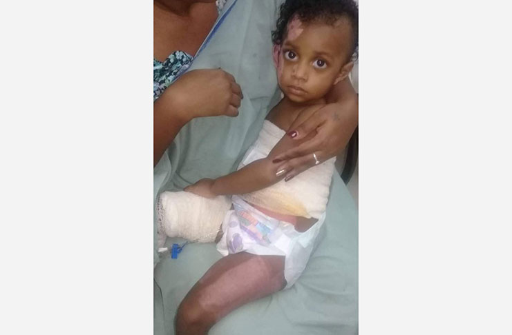 Little Afeena Marks who was severely burnt (SHEA photo)