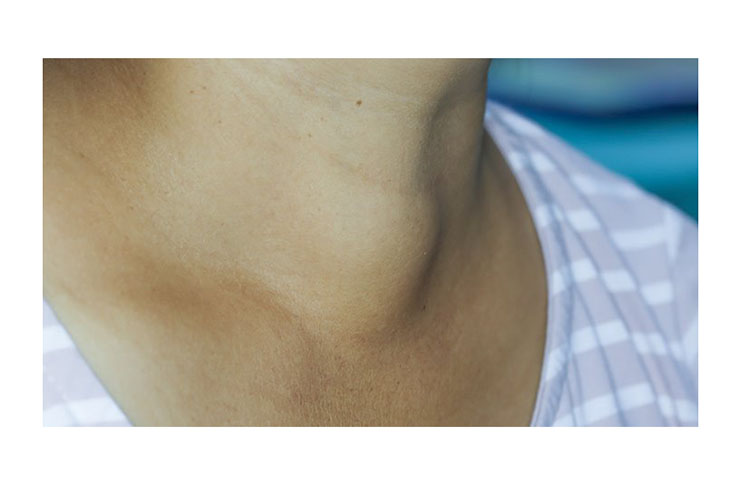 Swelling of the thyroid gland is a characteristic of a hyperthyroidism patient.