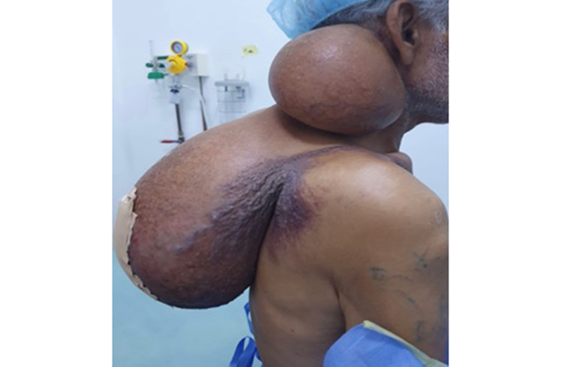 Before surgery: The 54-year-old old patient and the 10-year-old Lipoma
