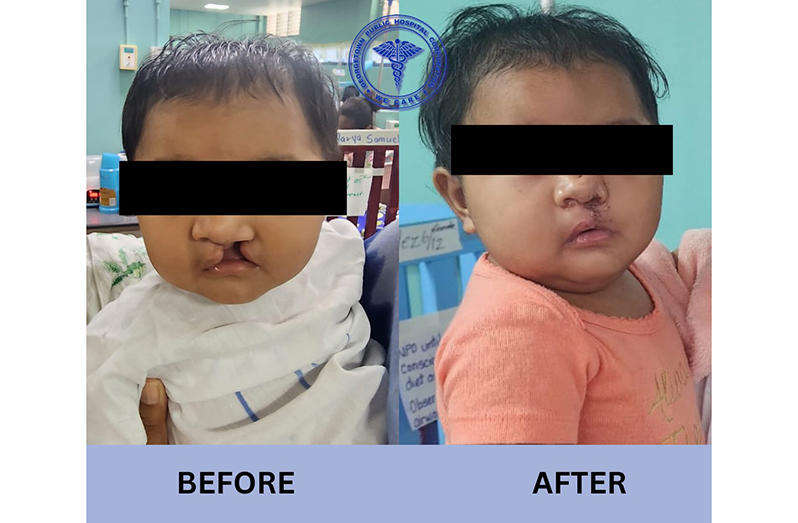 Over the weekend, the plastic surgery and maxillofacial teams at GPHC achieved a significant milestone by completing their second round of independent cleft surgeries with a total of nine successful procedures, including six cleft lip repairs and three cleft palate repairs