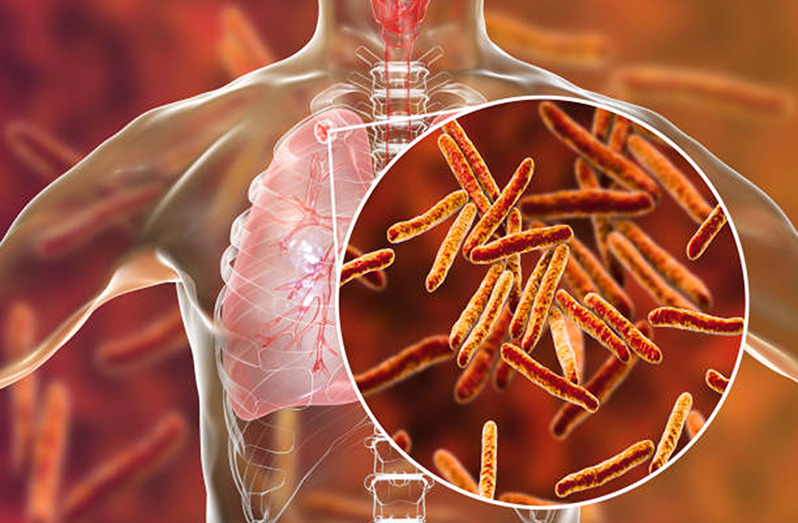 With comprehensive services and treatment in place for persons living with tuberculosis (TB), the Ministry of Health is making major strides in reducing TB incidence in the country