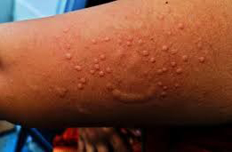 The most significant symptom of MPOX is a rash