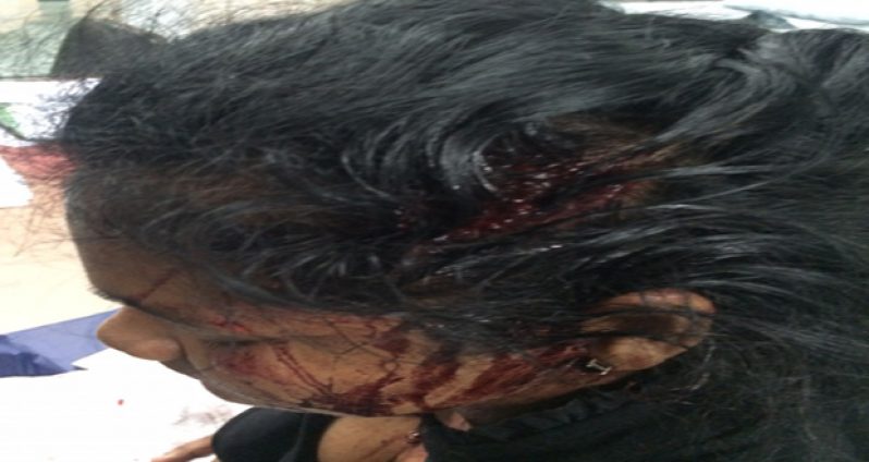 Nirvona Boodhoo, when she went to seek medical attention following the armed robbery outside her house in the wee hours of Monday morning (Rabindra Rooplall photos)