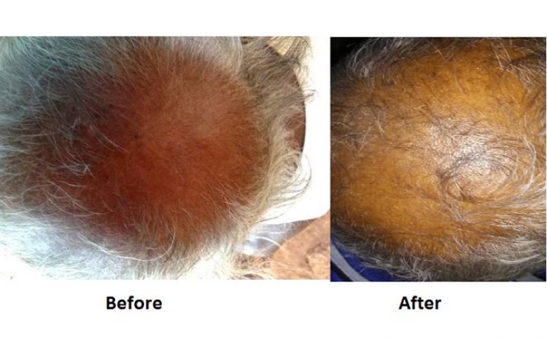 The results of treatment done on Dr Sevanie Williams’ grandfather’s hair