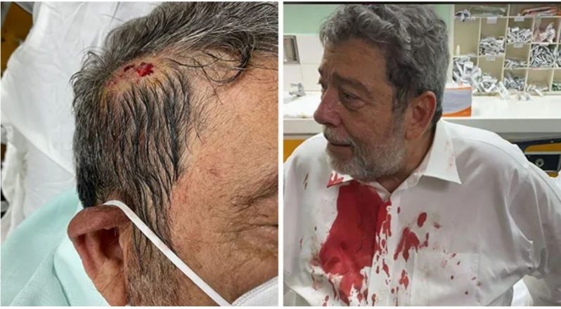 The injury inflicted on St. Vincent and the Grenadines Prime Minister, Ralph Gonsalves (IWN photo)