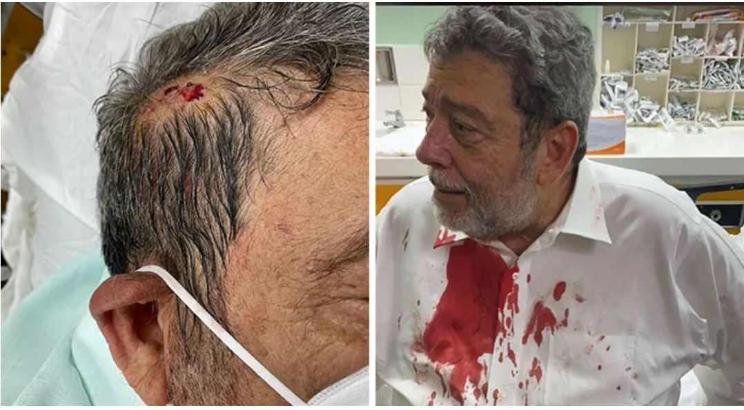 The injury inflicted on St. Vincent and the Grenadines Prime Minister, Ralph Gonsalves (IWN photo)