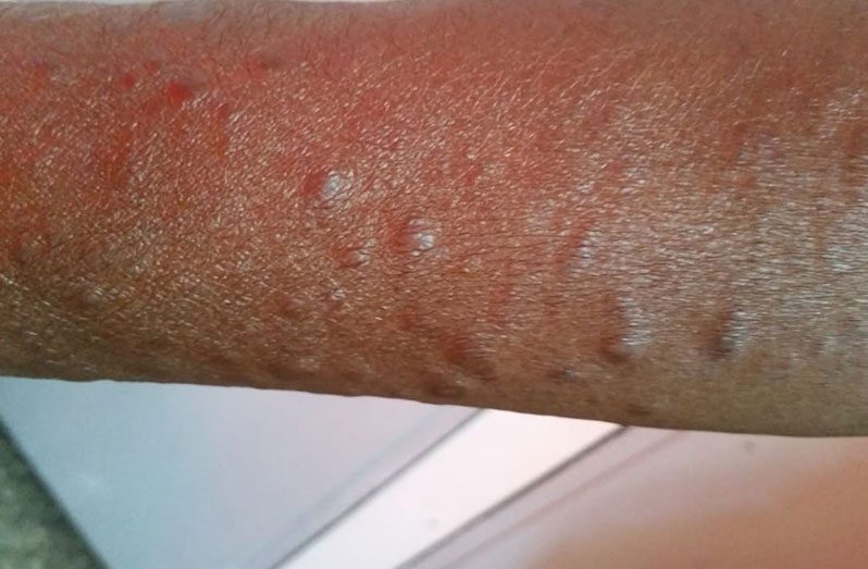 Dry skin, numbness or painful limbs can accompany lesions