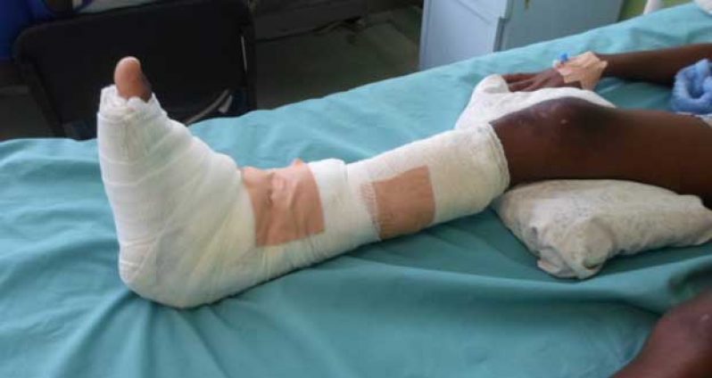 Kamal Rampersaud on the road to recovery after fracturing his leg in a swimming plunge into Canje River.