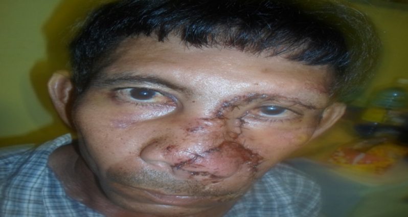 Still awaiting police intervention: Yethong Sueeyee, beaten and chopped on the face by the aggressors.