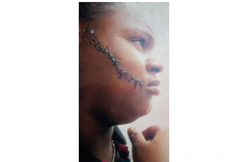 A scar on Playter’s cheek that she had received after one physical encounter with her reputed husband, Victor Roberts