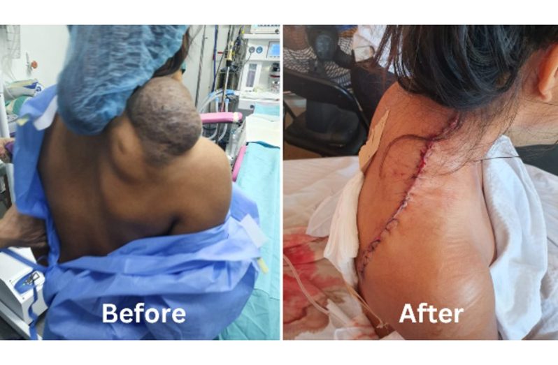 A 16-year-old patient has been given a fresh start in life following the removal of a large congenital hemangioma that affected her right shoulder