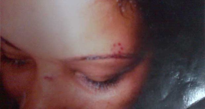 There are bruises over the eyes of Odessa Seenanan, which she said she received from her husband.