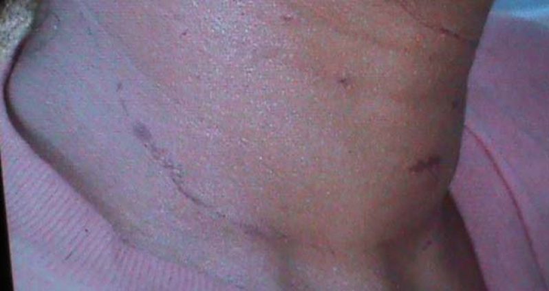 Victim’s neck swollen with bruises as a result of the rapist choking her