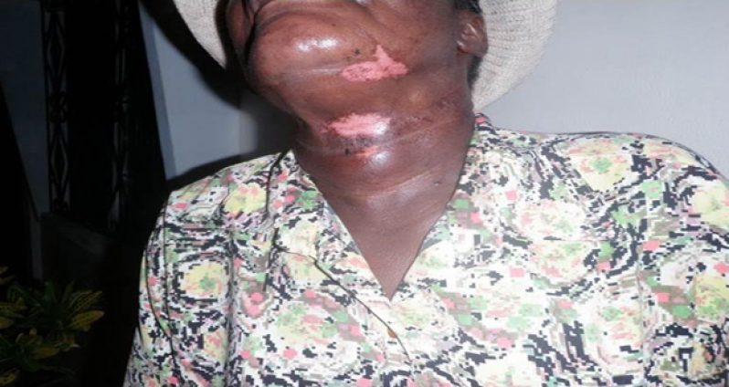 The Pastor's neck that is badly bruised after the bandit reportedly choked her