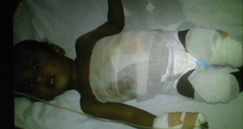 The badly burnt baby at the Georgetown Public Hospital