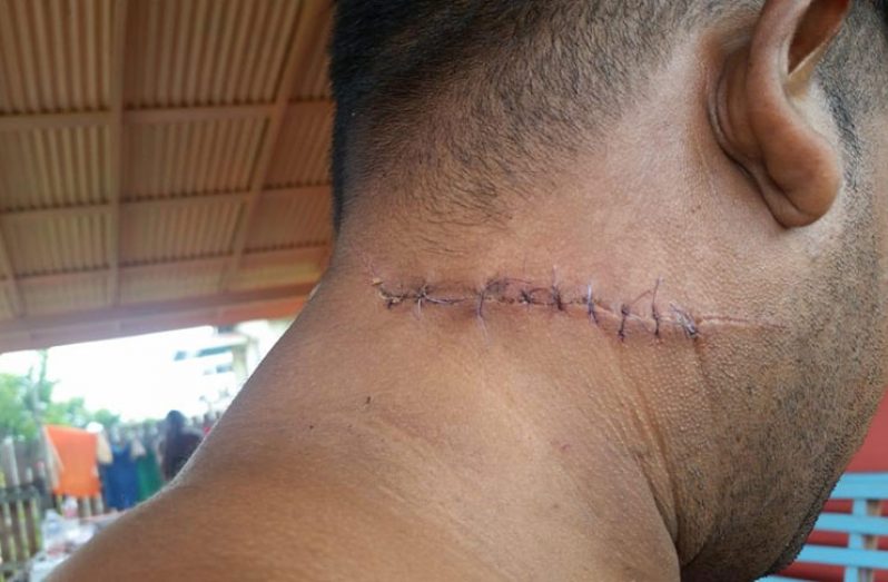 Stitches Persaud received for a chop to the neck during the protest