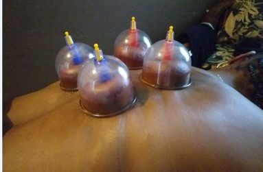 The cupping technique used by Seegopaul to treat back pain