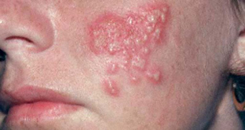 herpes_simplex_cutaneous_12