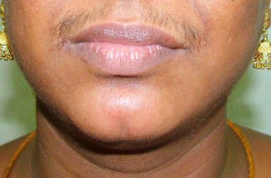 Facial hair is one of the symptoms associated with PCOS