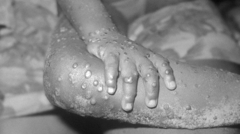 Human monkeypox cases are extremely rare (BBC/GETTY IMAGES)