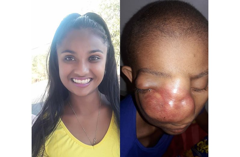 15-year-old Shaniece Nanhoe before and during her illness